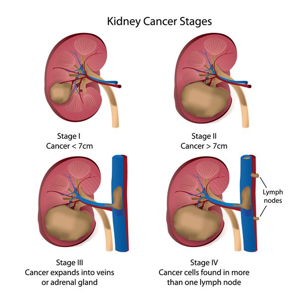 وکتور مراحل سرطان کلیه