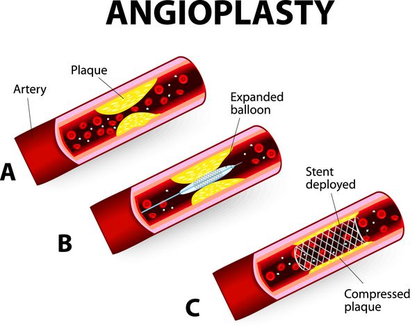 آنژیوپلاستی با بالون عروق کرونر نمودار برداری