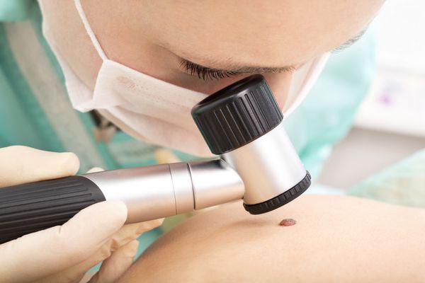 متخصص پوست خال مادرزادی بیمار را با درماتوسکوپ بررسی می کند معاینه خال درموسکوپی حرفه ای