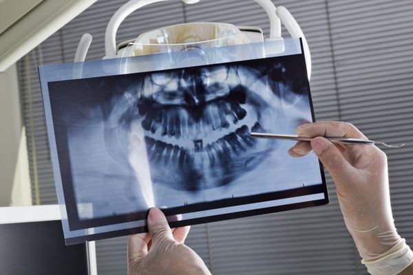 اشعه ایکس دندانپزشک