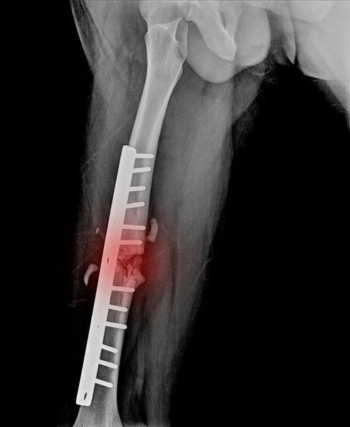 تصویر اشعه ایکس از شکستگی پای تیبیا با فیکساسیون خارجی ایمپلنت