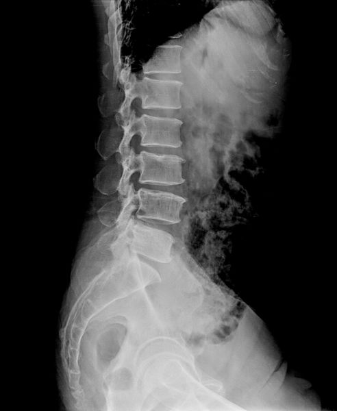 اسکن رادیوگرافی جانبی ستون فقرات سمت راست گرفته شده از جمله رادیوگرافی های دیگر برای شناسایی منشاء درد در لگن یک مرد بالغ