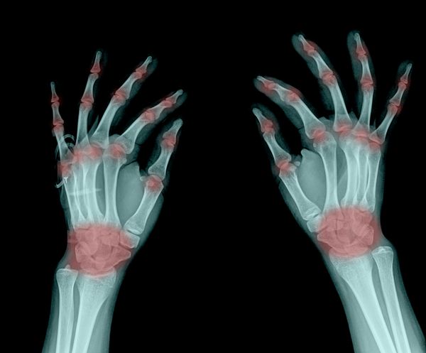 عکسبرداری با اشعه ایکس از دست انسان و آرتریت مفاصل متعدد نقرس روماتوئید