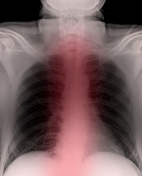 عکسبرداری با اشعه ایکس از ریه های انسان در حین ذات الریه