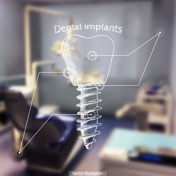 وکتور پس زمینه - تار شدن پو دندانپزشک با طرح - ایمپلنت های دندانی
