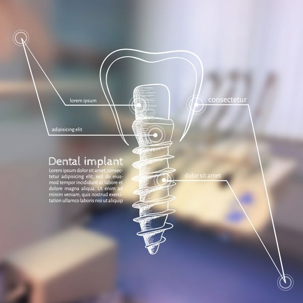 وکتور پس زمینه - تار شدن پو یک دندانپزشک با طرح اینفوگرافیک - ایمپلنت های دندانی