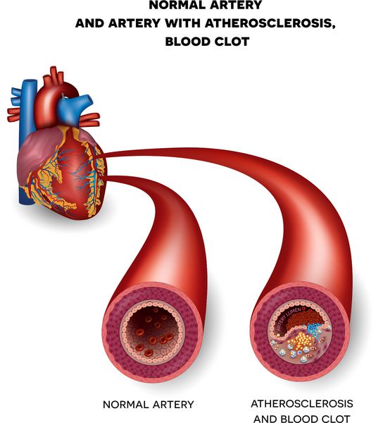شریان طبیعی و شریان ناسالم با لخته خون پارگی پلاک تصویر آناتومی دقیق لومن شریان تنگ شده و منجر به ترومبوز می شود