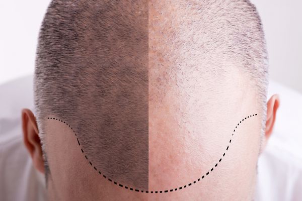 نمای بالای سر مردانه با خط موی عقب رفته - قبل و بعد