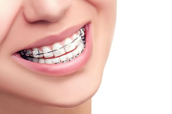 بریس درمان ارتودنسی مفهوم مراقبت از دندان لبخند سالم زن زیبا از نزدیک براکت سرامیکی و فلزی نمای نزدیک روی دندان لبخند زنانه زیبا با بریس