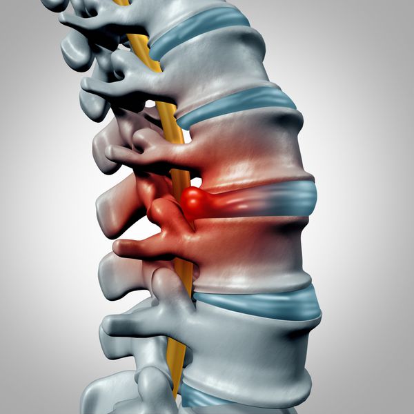 مفهوم فتق دیسک و تشخیص درد ستون فقرات به عنوان نماد سیستم نخاعی انسان به عنوان مشکل سلامت پزشکی و نماد آناتومی با ساختار استخوان اسکلتی و دیسک های بین مهره ای نزدیک