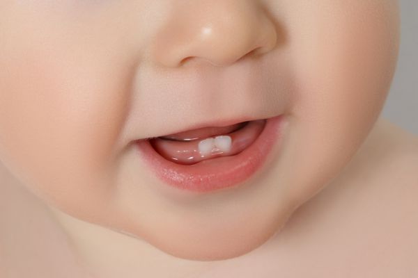 دهان کودک از نمای نزدیک با دو دندان بالارونده