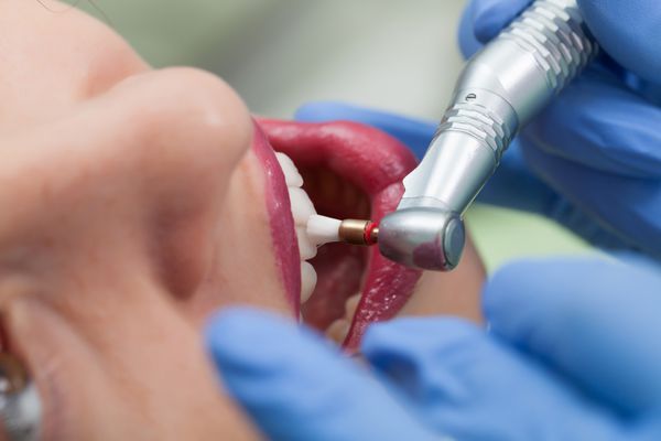 رویه دندانپزشکی از نمای نزدیک برای پولیش دندان