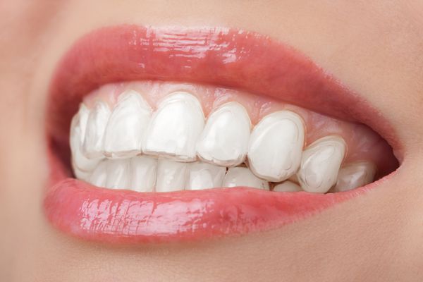 دندان با سینی سفید کننده لبخند دندان