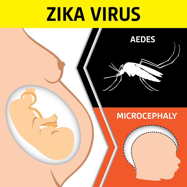 تصویری از یک نوزاد تازه متولد شده با بیماری میکروسفالی ویروس زیکا aedes ایده آل برای بهداشت و پزشکی مرتبط با اطلاعات و سازمانی