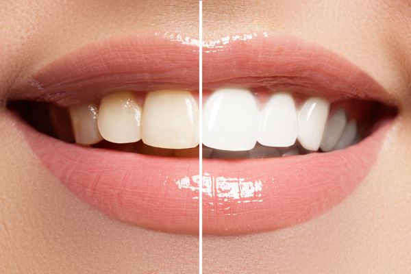 لبخند کامل قبل و بعد از بلیچینگ مراقبت از دندان و سفید کردن دندان