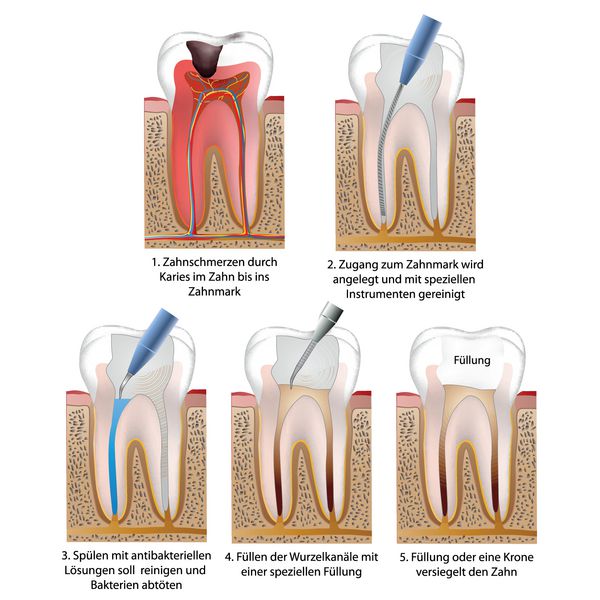 darstellung einer wurzelbehandlung vektor illustration deutsch