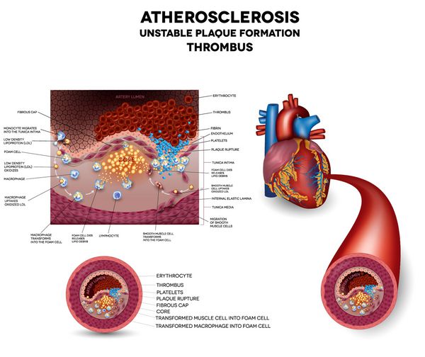 لخته خون پارگی پلاک و تشکیل لخته خون آسیب عضله قلب تصویر بسیار دقیق