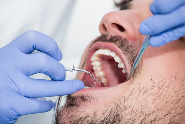 روش حذف پلاک دندان