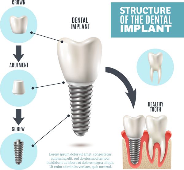 پوستر اینفوگرافیک پزشکی ساختار ایمپلنت دندان