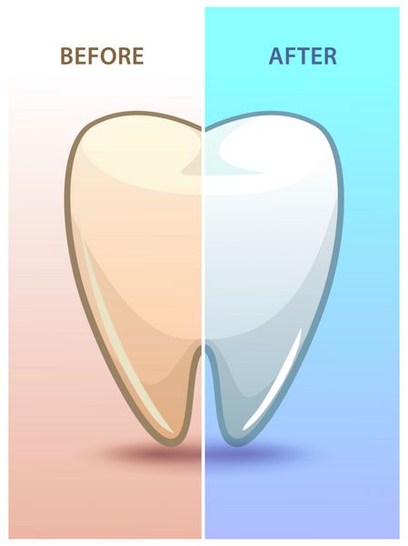 کارتون دندان قبل و بعد از سفید کردن