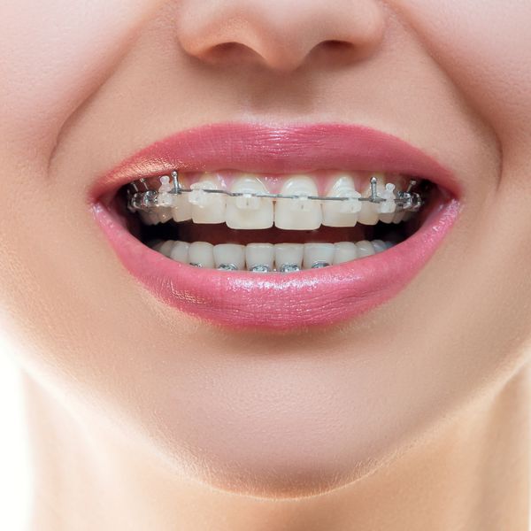 دندان با بریس مفهوم مراقبت از دندان نمای جلو با بریس های یاقوت کبود لبخند بزنید فاصله بین دندان ها درمان ارتودنسی