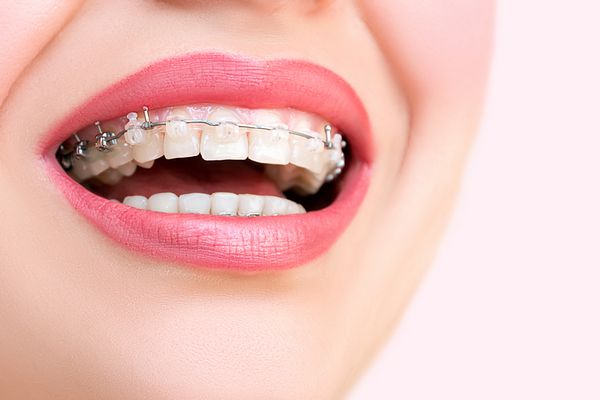 دهان باز را با بریس های سرامیکی و فلزی روی دندان های زیبا نزدیک کنید لبخند پهن با براکت های خود بستن درمان ارتودنسی زنی خندان در حال نمایش بریس های دندانی