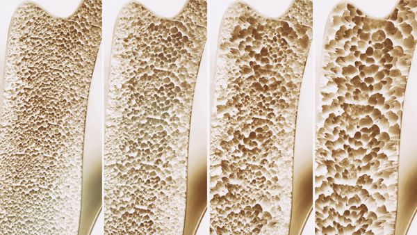 پوکی استخوان 4 مرحله در یک تصویر - رندر سه بعدی