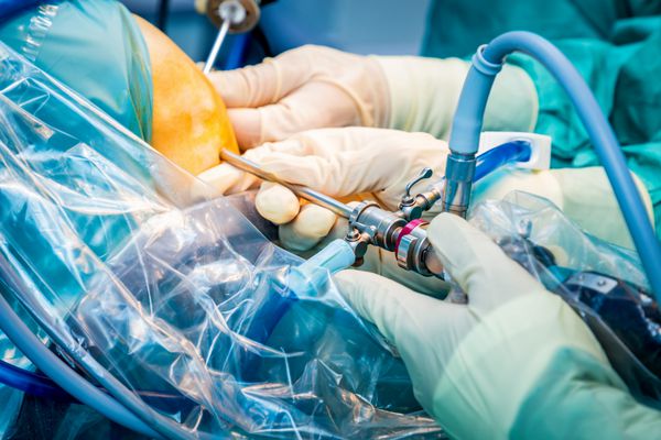 جراحان ارتوپد در کار تیمی در اتاق عمل با ابزارهای آرتروسکوپی مدرن جراحی سوراخ کلید را پس از آسیب جدی مفصل زانو بر روی ترومای انسانی انجام می دهند
