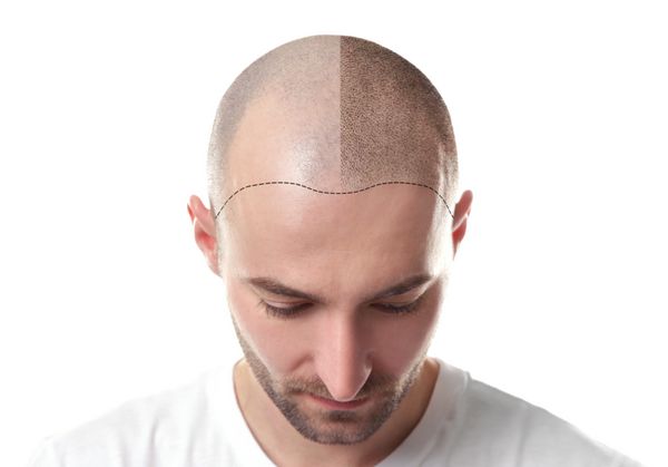 مرد قبل و بعد از درمان ریزش مو در زمینه سفید