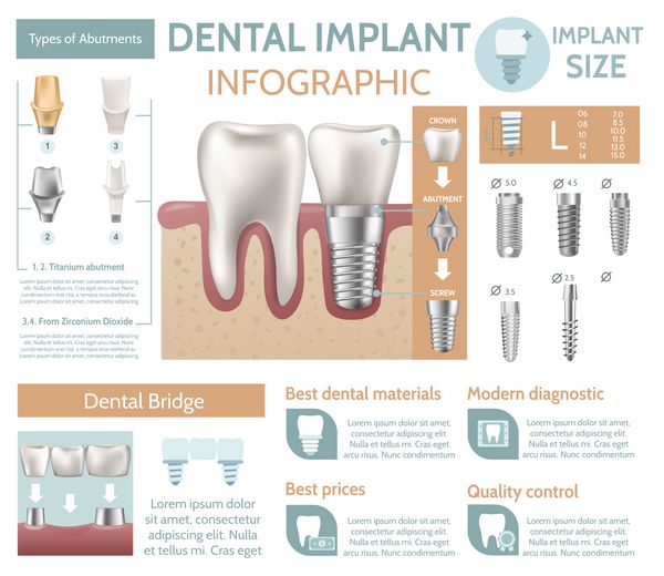 مراقبت از ایمپلنت دندان مرکز پزشکی کلینیک دندانپزشکی وب سایت اینفوگرافی پوستر تصویر وکتور