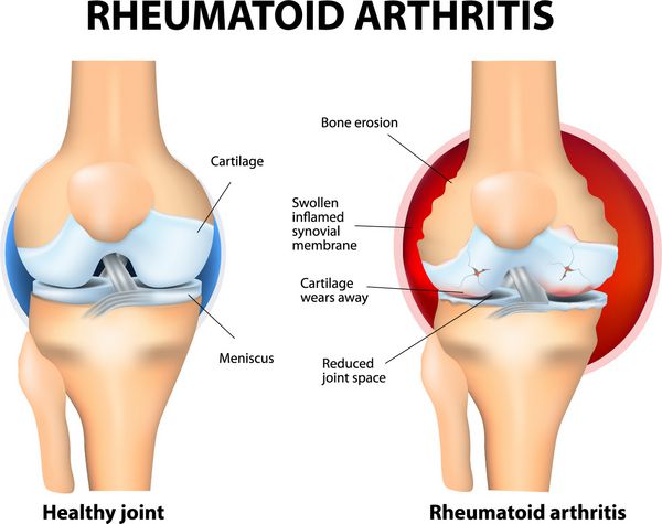 Rheumatoid Arthritis RA is an inflammatory type of arthritis that usually affects knees the auto immune disease The body