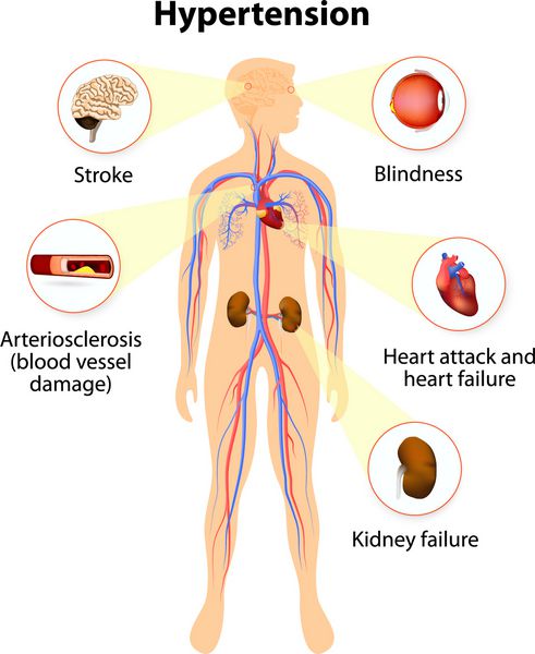 آسیب از فشار خون بالا فشار خون بالا خطر حمله قلبی سکته مغزی و نارسایی کلیه را افزایش می دهد