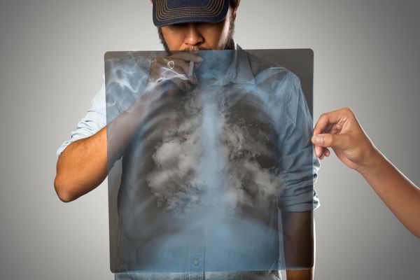 مرد سیگاری با ریه اشعه ایکس جدا شده در پس زمینه خاکستری