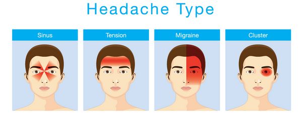 تصویر در مورد انواع سردرد 4 نوع در منطقه مختلف سر بیمار