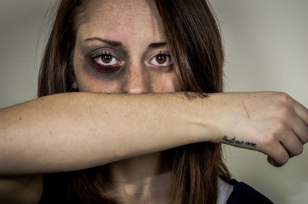 دختر با زخمی در چهره نگاه به دوربین با نگاه عمیق مردم قفقاز مفهوم خشونت علیه زنان