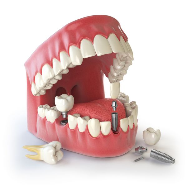ایمپلنت دندان انسان مفهوم دندانپزشکی دندان های انسانی یا پروتزهای انسانی تصویر 3D
