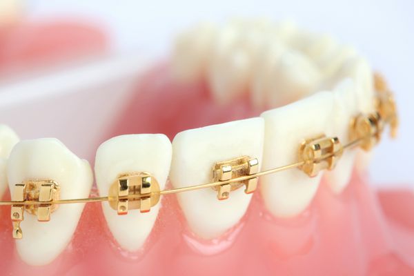 دندان مصنوعی با پرانتز