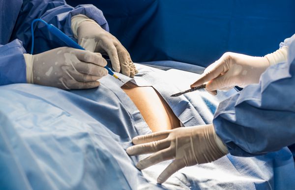 دستیار در دستکش های پزشکی نگه داشتن یک اسکنر ارسال به دست جراح برای شروع کار در اتاق عمل تیم جراحی واقعی در اتاق عمل جراحان انجام جراحی در اپراتور