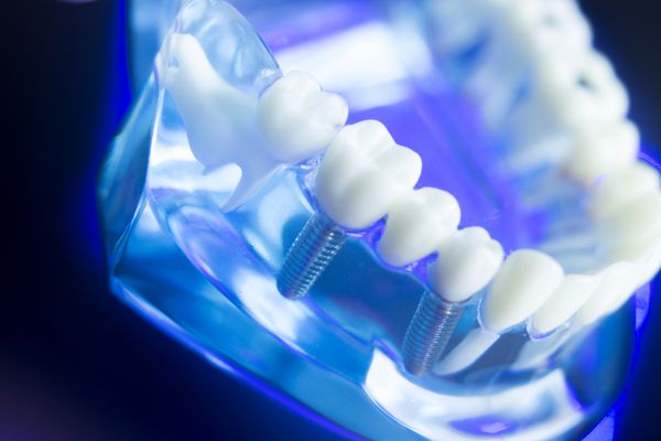 مدل دندانپزشکی دندانپزشکی دندانپزشکی با لثه مینای دندان پلاک ریشه و ایمپلنتهای فلزی