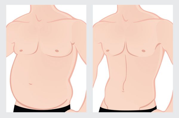شکم چربی مرد قبل و بعد از درمان تصویر برداری بر روی زمینه سفید فایل صاف نیست