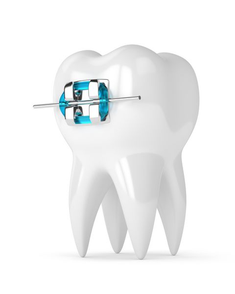3D رندر دندان با brace جدا شده بر روی زمینه سفید