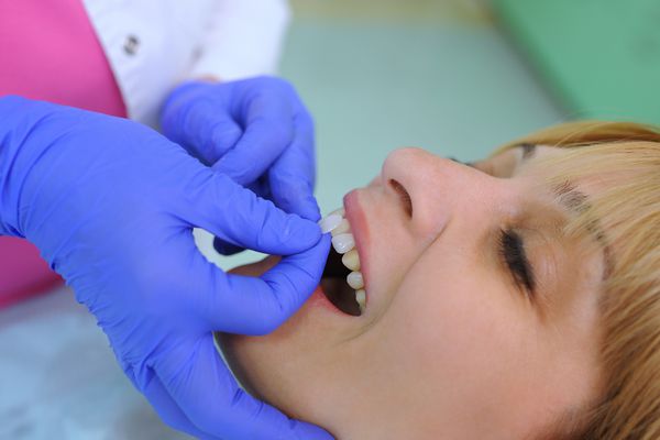 دندانپزشک ونیرهای دندان را بیمار و اصلاح دندان ها قرار می دهد