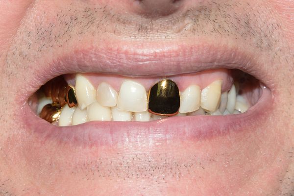 تاج دندان طلای قدیمی در دهان بیمار در کلینیک دندانپزشکی