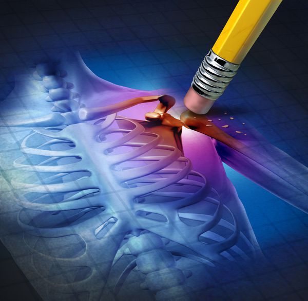 تسکین درد شانه انسان با اشعه ایکس آناتومی بدن با ناحیه دردناک که توسط یک مداد به عنوان یک نماد پزشکی مراقبت های بهداشتی ناشی از تصادف یا ورم مفاصل به عنوان یک درمان مفصل اسکلتی پاک می شود