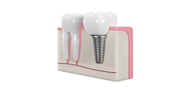 دندان کاشت دندان