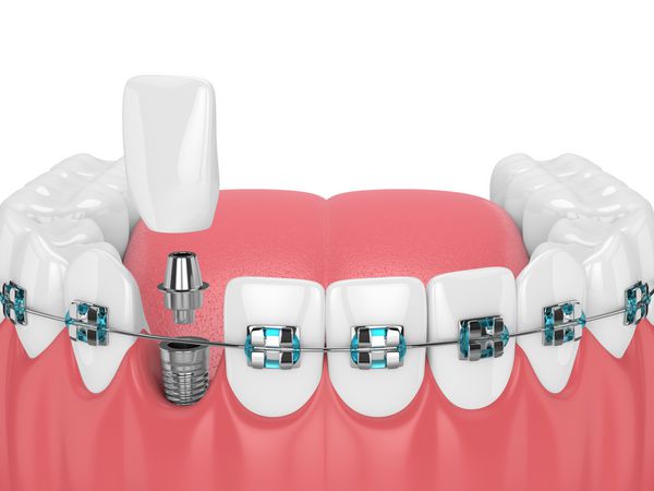 رندر سه بعدی دندانها با بندهای ارتودنسی و ایمپلنت دندان مفهوم پرانتز ارتودنسی