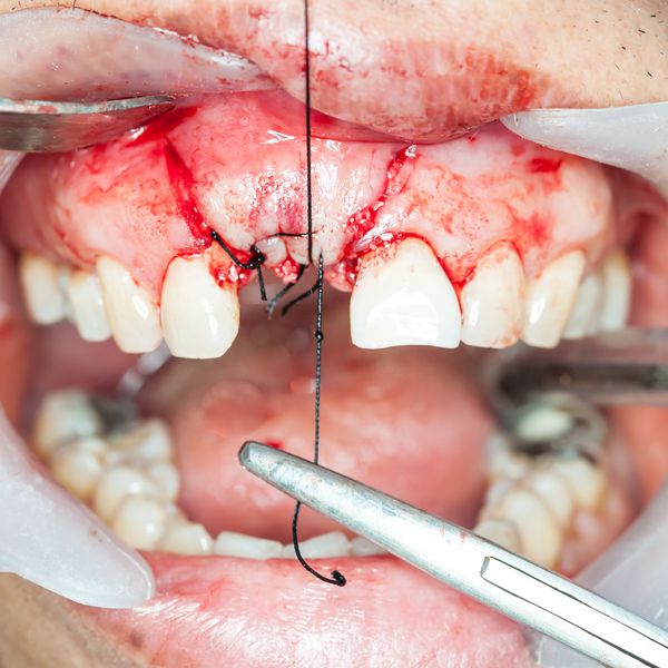 جراحی کاشت دندان در بیمار واقعی