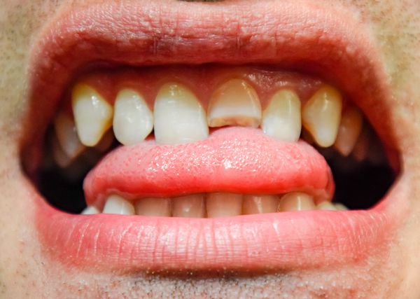 دندان شکسته ليزر بالا شکسته در دهان مرد مرد حفره دهان را به دندانپزشک نشان می دهد درمان دندان شکسته