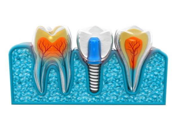 فرآیند نصب کاشت دندان 3D ارائه می شود