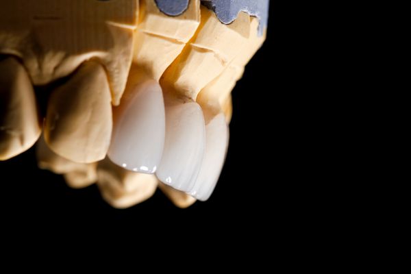 روکش دندانهای جلو سفید روی مدل تشخیصی در زمینه تاریک نزدیک